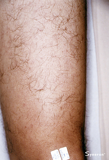 Post 2 Treatments Leg Hair Removal